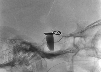 കേരളത്തിലാദ്യമായി സില്‍ക്ക് വിസ്ത സ്‌റ്റെന്റ് പ്രക്രിയ വിജയകരമാക്കി ആസ്റ്റര്‍ മെഡ്‌സിറ്റി