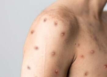 സൗദി അറേബ്യ എംപോക്സ് മുക്തമെന്ന് പബ്ലിക് ഹെല്ത്ത് അതോറിറ്റി